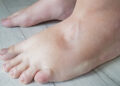 تورم القدمين : الأسباب والحلول وطرق العلاج