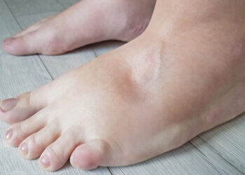 تورم القدمين : الأسباب والحلول وطرق العلاج