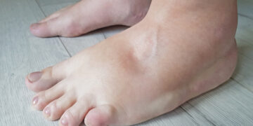 تورم القدمين : الأسباب والحلول وطرق العلاج