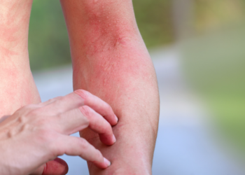 Comment identifier une réaction allergique cutanée ?