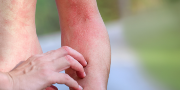 Comment identifier une réaction allergique cutanée ?