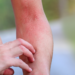 Comment identifier une réaction allergique cutanée ?