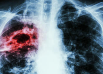 La Tuberculose au Maroc : Où en Sommes-Nous ?