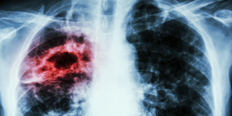 La Tuberculose au Maroc : Où en Sommes-Nous ?
