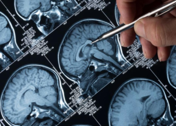 Alzheimer : Un Traitement Innovant Enfin Approuvé en Grande-Bretagne