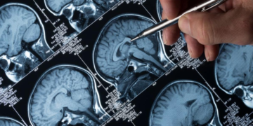 Alzheimer : Un Traitement Innovant Enfin Approuvé en Grande-Bretagne