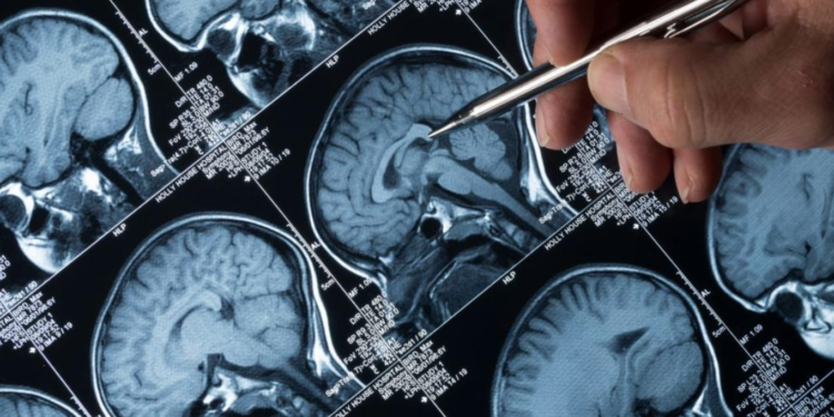 Alzheimer : Un Traitement Innovant Enfin Approuvé en Grande-Bretagne