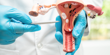 Cancer du col de l’utérus : Questions Réponses