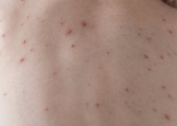 Le ministère de l’Éducation prolonge la campagne de sensibilisation contre la rougeole