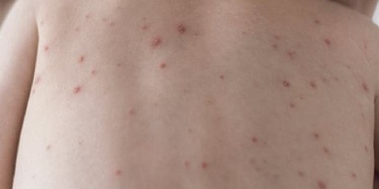 Le ministère de l’Éducation prolonge la campagne de sensibilisation contre la rougeole