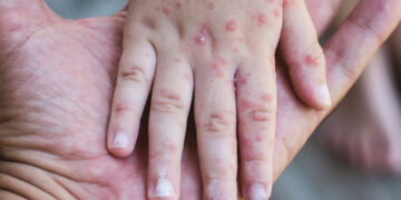 Rougeole au Maroc : L’importance de la vaccination pour la santé publique