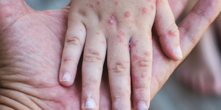 Rougeole au Maroc : L’importance de la vaccination pour la santé publique