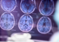 Alzheimer : un algorithme innovant pour détecter la maladie avant les symptômes
