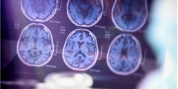 Alzheimer : un algorithme innovant pour détecter la maladie avant les symptômes