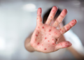 Rougeole : L’augmentation des cas pousse les parents à renforcer la vaccination des enfants