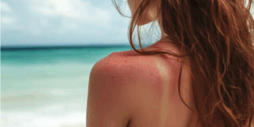 À l’approche de l’été, l’OMS alerte sur les dangers du bronzage