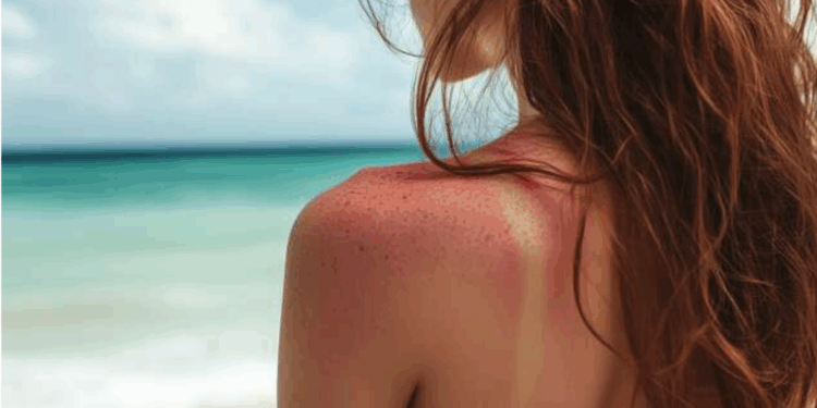 À l’approche de l’été, l’OMS alerte sur les dangers du bronzage